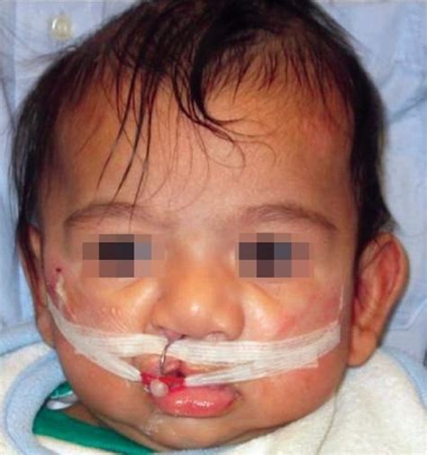 presurgical nasoalveolar molding treatment in cleft lip and palate patients