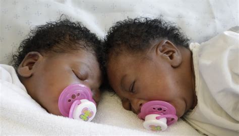 eastern cape girls born joined at the head successfully separated