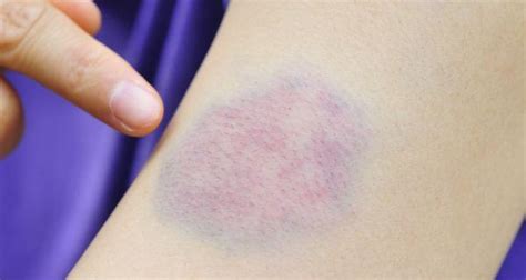 8 reasons for unexplained bruises on your body read health related