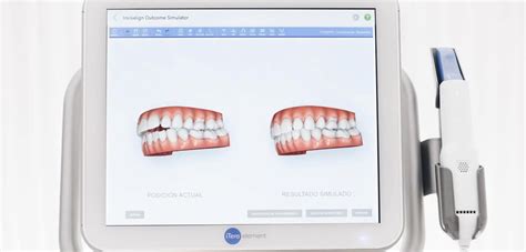 ¿qué Es El Escáner Intraoral Itero Su Uso En Ortodoncia Invisalign