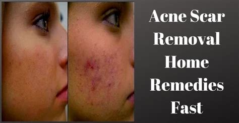 Acne Scar Removal Home Remedies Fast Best Health N Care