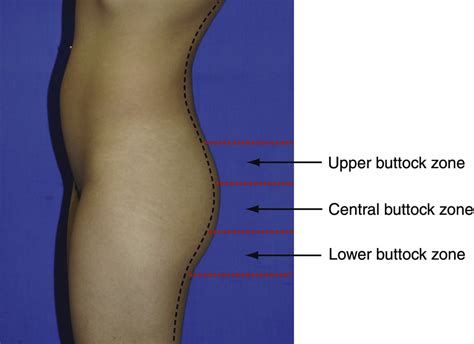 Classification System For Gluteal Evaluation Clinics In Plastic Surgery