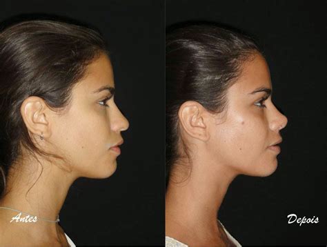 Rinoplastia Antes E Depois Fotos Antes E Depois Da