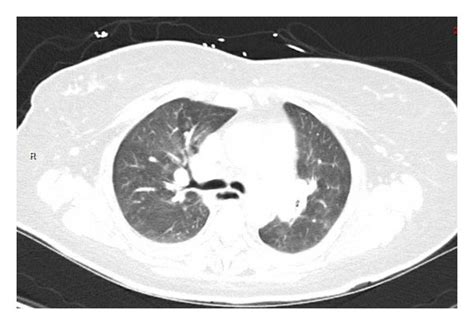 Chest Computed Tomography Revealing Mediastinal And Hilar