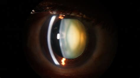 slit lamp examination   anterior segment   eye youtube