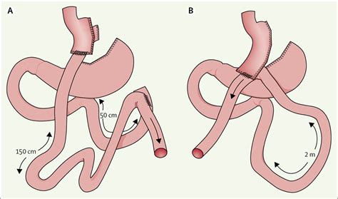 Efficacy And Safety Of One Anastomosis Gastric Bypass