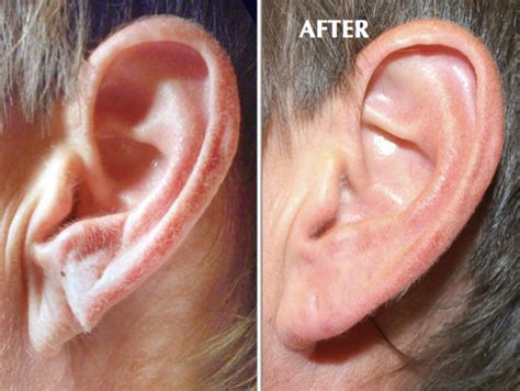 Fillers For Ear Lobes Glow Medical Aesthetics Tulsa Botox