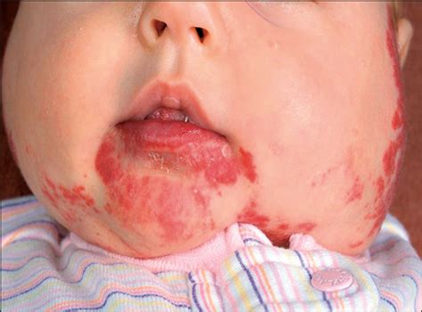 clinical spectrum and risk of phace syndrome in cutaneous and airway hemangiomas congenital