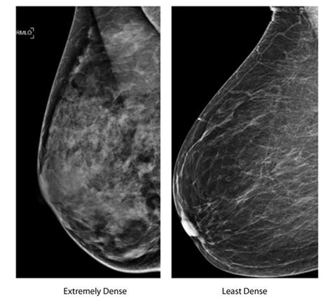 mammograms and dense breasts questions abound