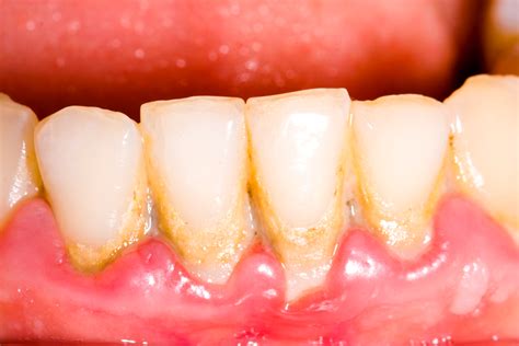 gums swollen   teeth teethwalls