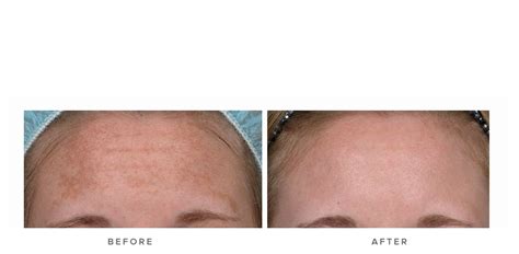 acne scars treatment fraxel laser sydney laser treatment