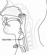 Tracheostomy Ventilator Dependence Trach Situ Asha Dependent sketch template