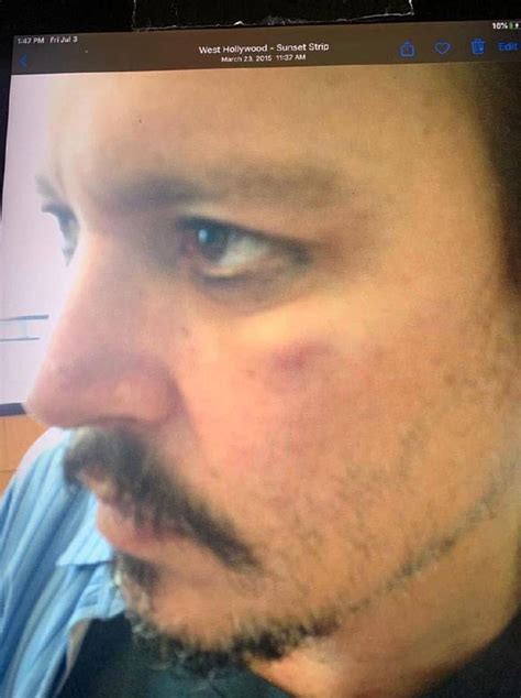 Johnny Depp S Scratched And Bruised Face After Being