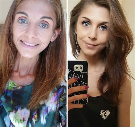 45 ‘before And After’ Photos Of People Who Beat Anorexia