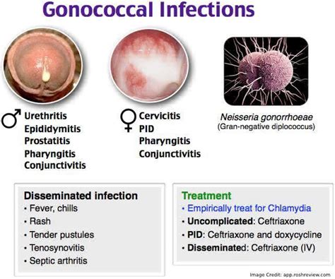 Gonococcal Arthritis An Overview Of This Extremely Rare Arthritis
