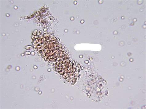 microscopic urinalysis pictures flashcards quizlet