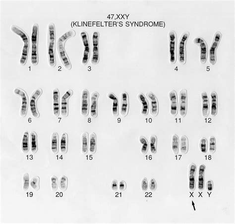 Klinefelters Syndrome Karyotype 47 Xxy Wellcome Collection