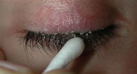 rid  eyelash dandruff   effective solutions