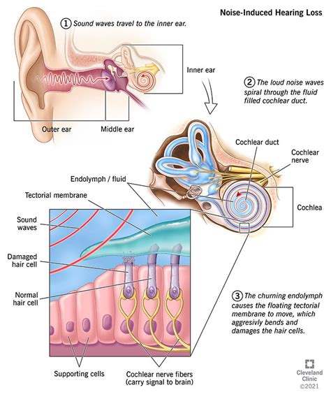 noise induced hearing loss nihl symptoms treatment