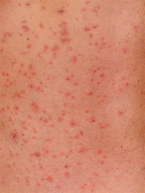 scabies causes symptoms treatment pictures and images