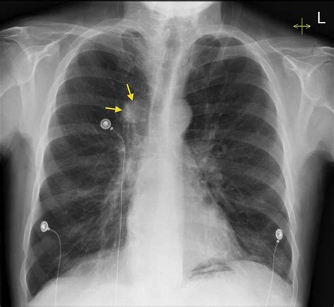 lung cancer cxr radiology  st vincents university hospital