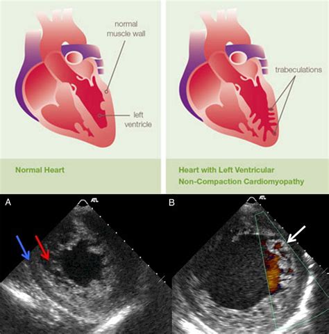 left ventricular  compaction cardiomyopathy  grepmed