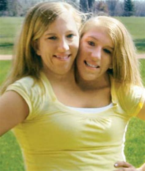 female adult siamese twins pictures
