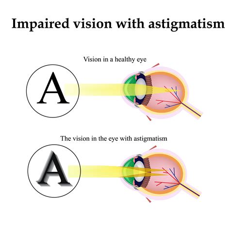 ive  astigmatism    lasik vision