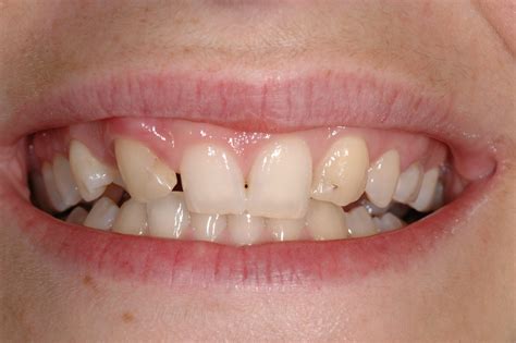gebitsrenovatie met een mooi resultaat laat uw weer tanden stralen