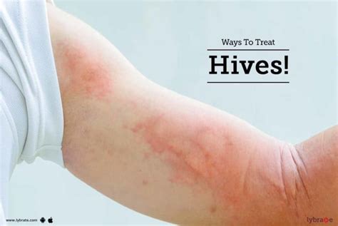 Ways To Treat Hives By Dr Jyotsna Deo Lybrate