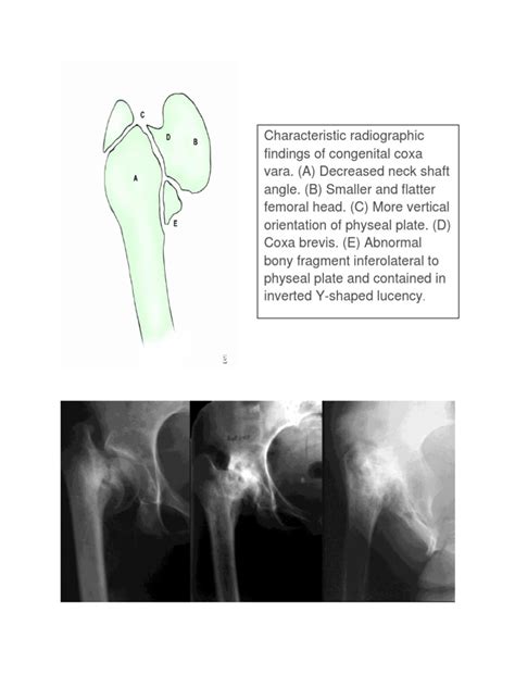coxa vara bone musculoskeletal system prueba gratuita de  dias scribd