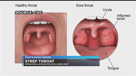 what s going around strep throat