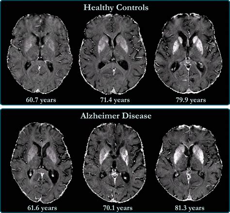 brain iron accumulation linked  cognitive decline  alzheimers patients