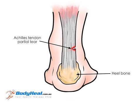 tendinitis patients  present   painful overuse tendon
