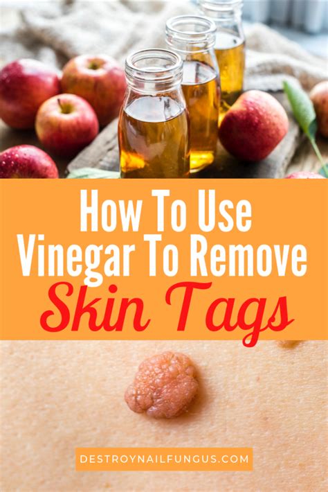 how to use apple cider vinegar to remove skin tags