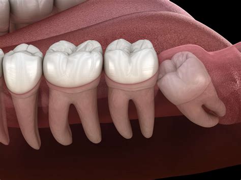 Wisdom Teeth And Health When You Need Free Removal