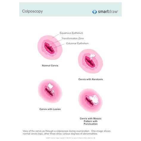 colposcopy