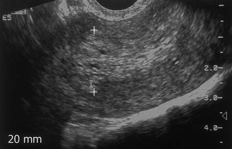 transvaginal us and hysterosonography in postmenopausal women with