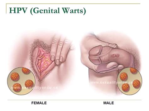 Testimony On Genital Warts Is A Products Of A Sexually