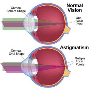 astigmatism christopherson eye clinic