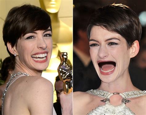 Anne Hathaway Photos Celebrities Without Teeth Ny Daily News