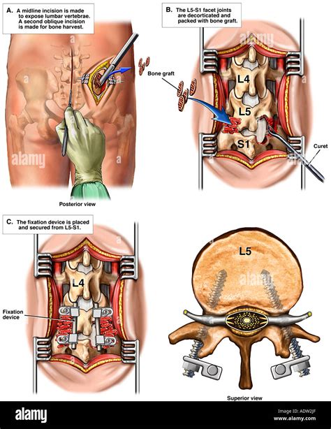 Recurrent L5 S1 Disc Herniation With Additional Surgical