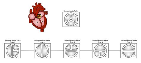 Another Milestone For Ua Banner Tucson Structural Heart Team—first Ever