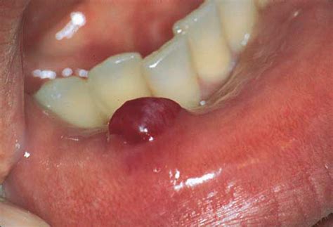 dentistry  medicine mucocele ranula  dermoid cyst short note