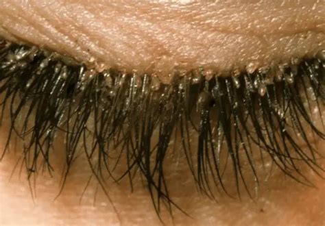 eyelash mites   prevention