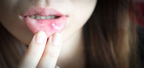 8 Causes Of A Mouth Ulcer Facty Health