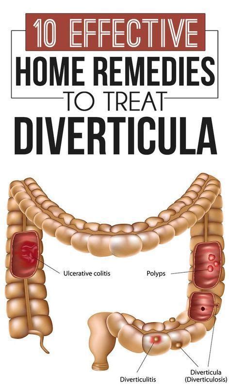 top  home remedies  colon cleansing diverticulitis