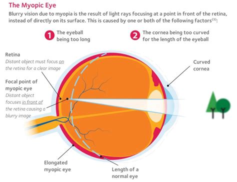 myopia risk check mata clinic optometrist blog