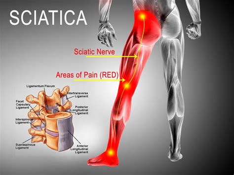 sciatica advanced sports family chiropractic acupuncture