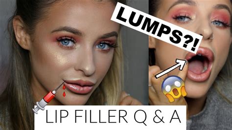 Do Lip Fillers Leave Lumps